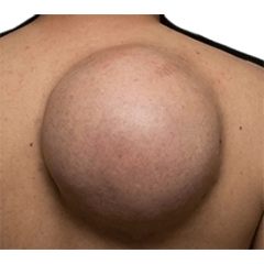 BIG! 粉瘤　実写